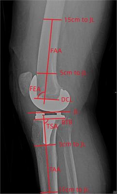 Correlation between component alignment and short-term clinical outcomes after total knee arthroplasty